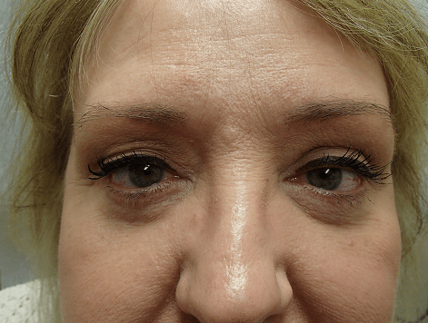 Blepharoplasty After