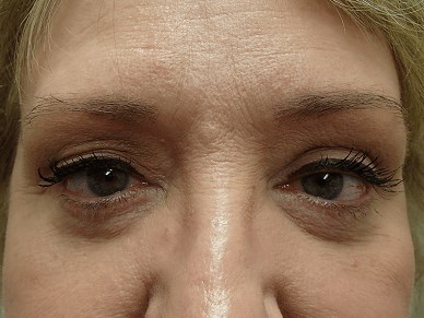Blepharoplasty After