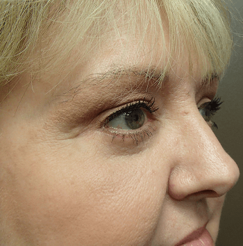 Blepharoplasty After