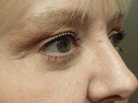 Blepharoplasty After