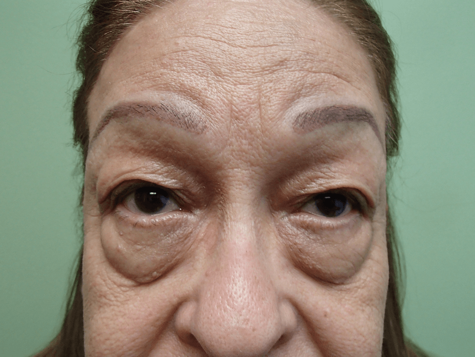 Blepharoplasty Before
