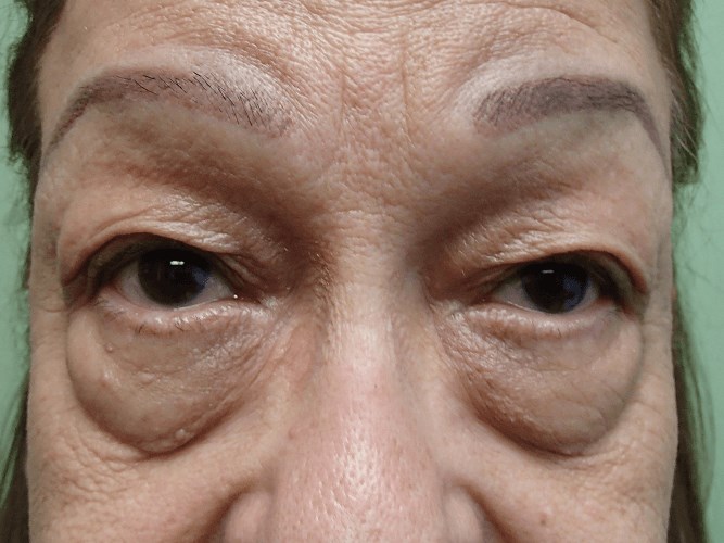 Blepharoplasty Before