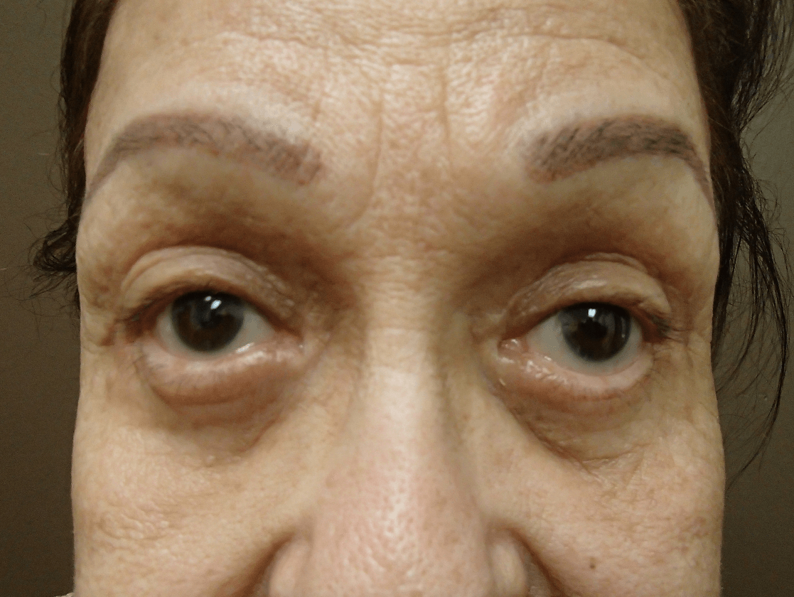 Blepharoplasty After