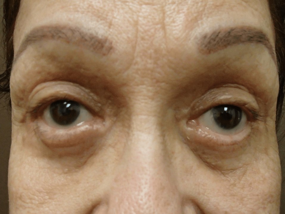 Blepharoplasty After