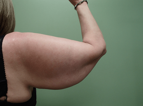 Brachioplasty and Liposuction Before