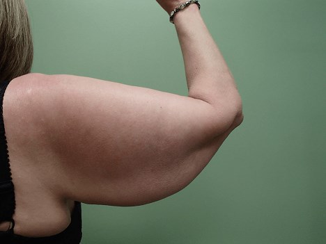 Brachioplasty and Liposuction Before