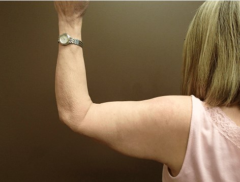 Brachioplasty and Liposuction After