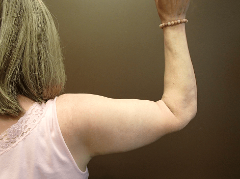 Brachioplasty and Liposuction After