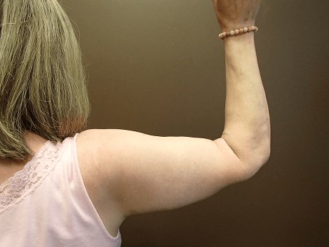 Brachioplasty and Liposuction After