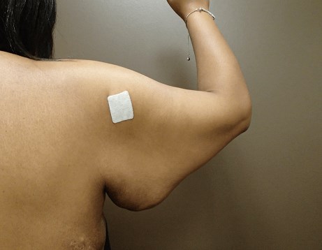 Brachioplasty and Liposuction Before