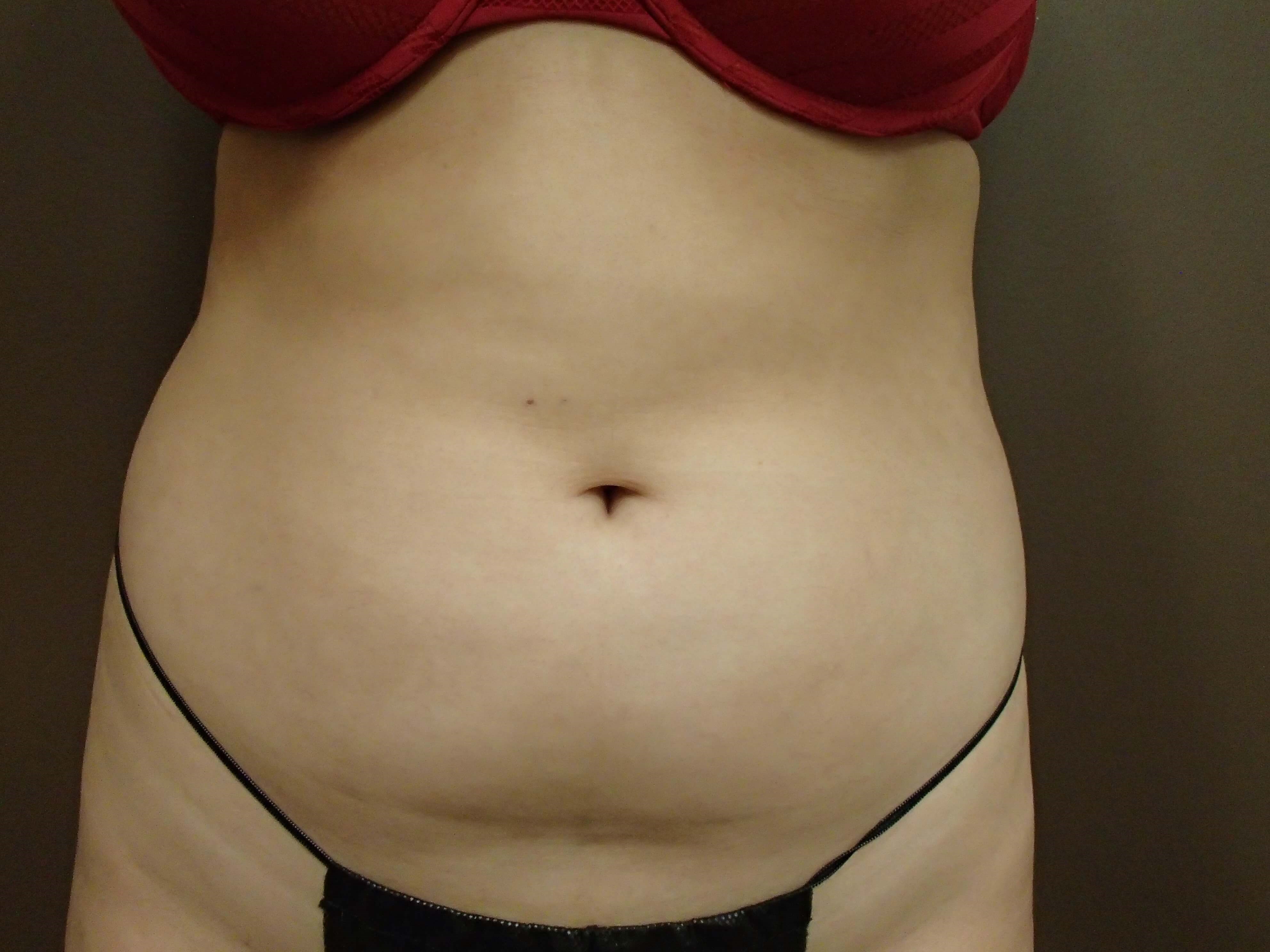 Liposuction Before