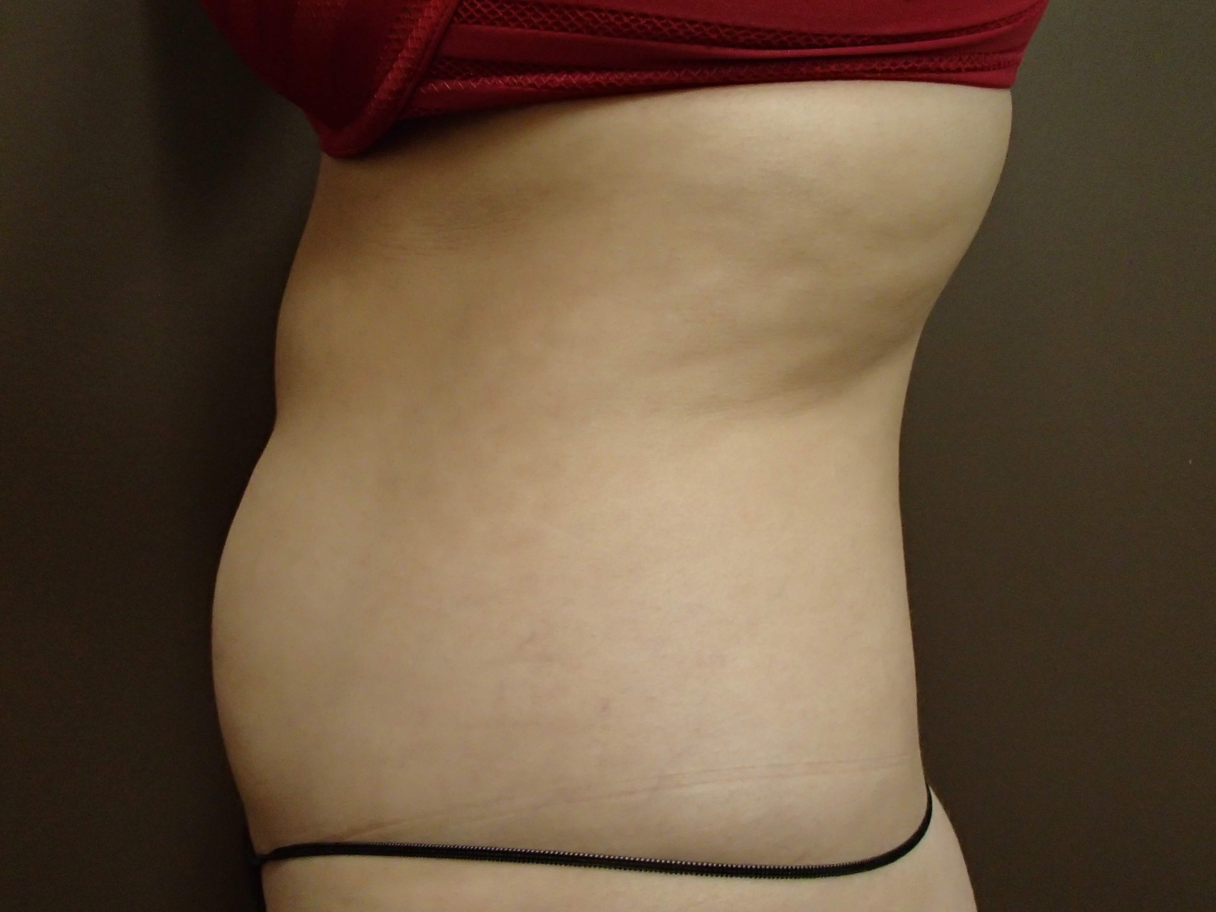 Liposuction Before