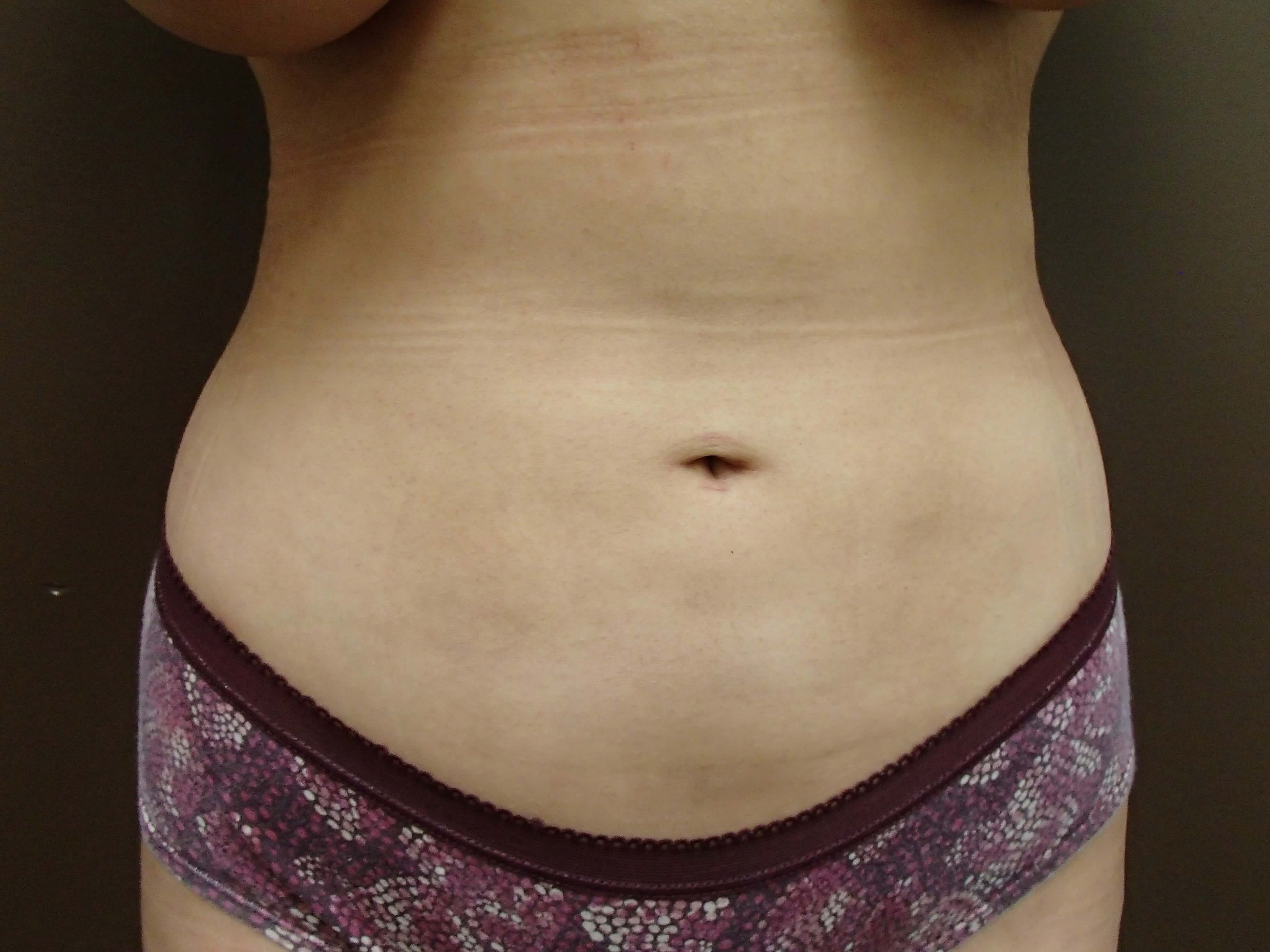 Liposuction After
