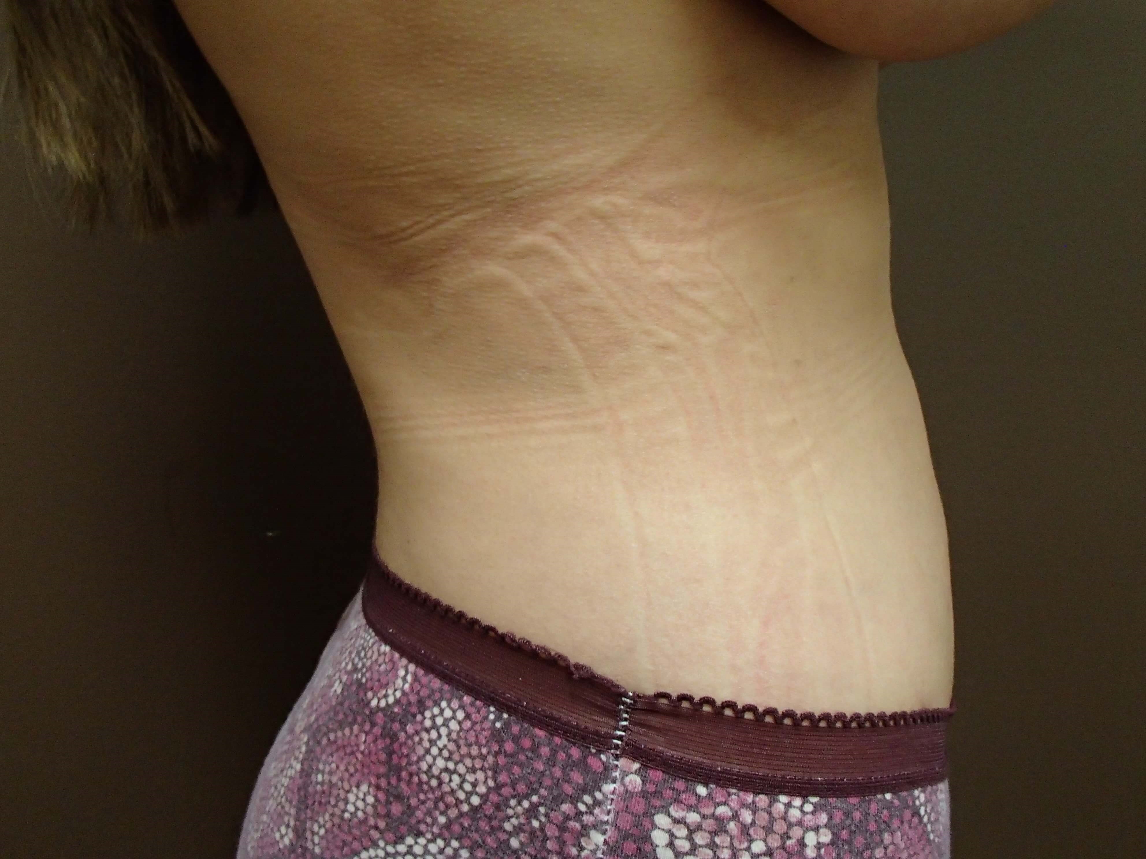 Liposuction After