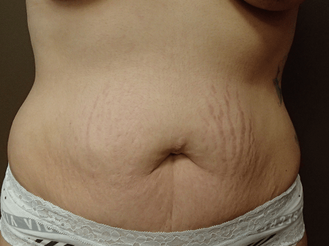 Abdominoplasty and Liposuction Before