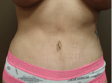 Abdominoplasty and Liposuction After