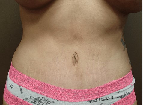 Abdominoplasty and Liposuction After