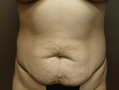 Abdominoplasty and Liposuction Before
