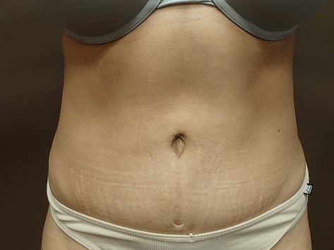 Abdominoplasty and Liposuction After