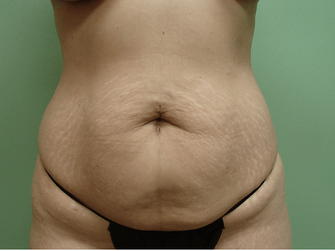 Abdominoplasty and Liposuction Before