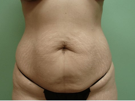 Abdominoplasty and Liposuction Before