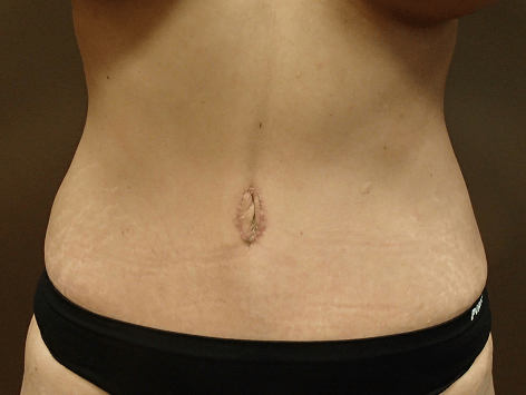 Abdominoplasty and Liposuction After