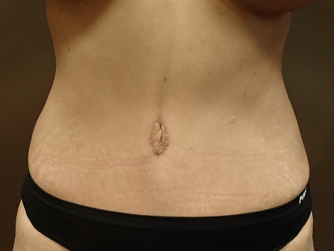 Abdominoplasty and Liposuction After