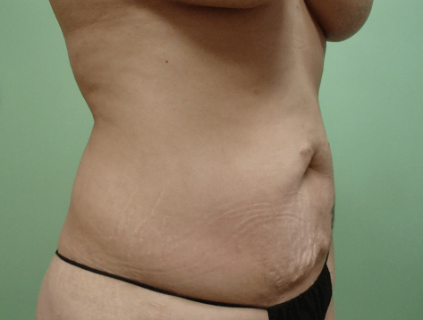 Abdominoplasty and Liposuction Before
