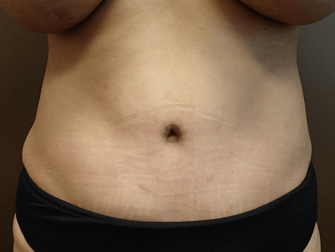 Abdominoplasty and Liposuction After