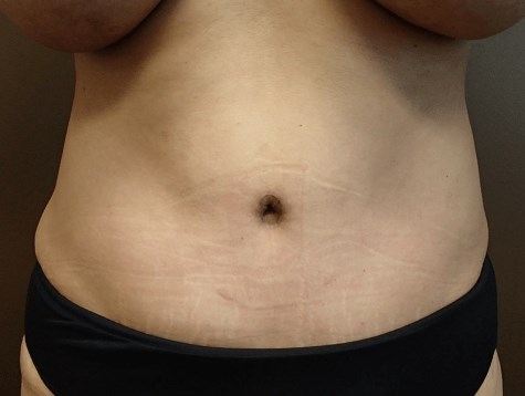 Abdominoplasty and Liposuction After