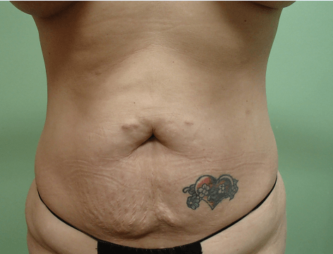 Abdominoplasty and Liposuction Before