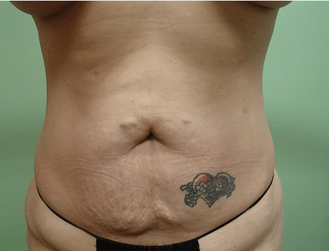 Abdominoplasty and Liposuction Before