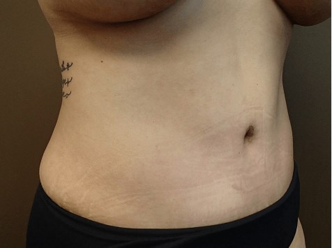 Abdominoplasty and Liposuction After