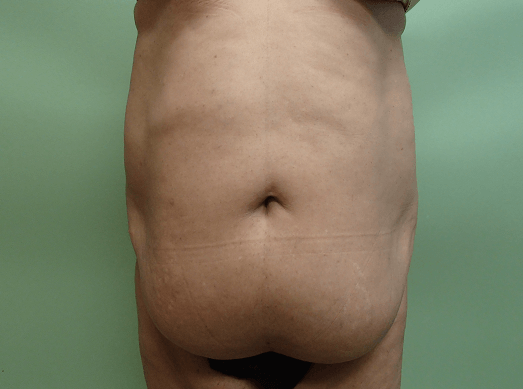 Timeless Tuck with Liposuction Before