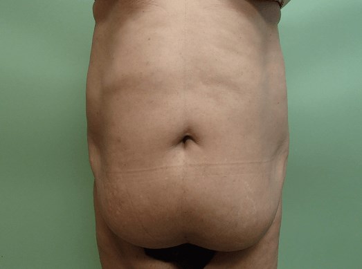 Timeless Tuck with Liposuction Before