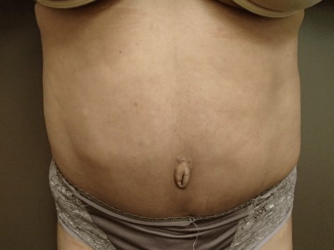 Timeless Tuck with Liposuction After