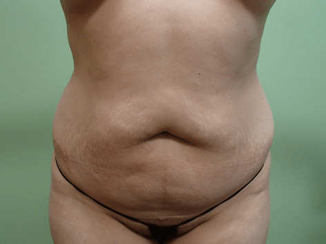 Abdominoplasty and Liposuction Before