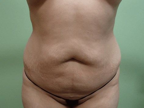 Abdominoplasty and Liposuction Before