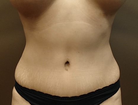 Abdominoplasty and Liposuction After