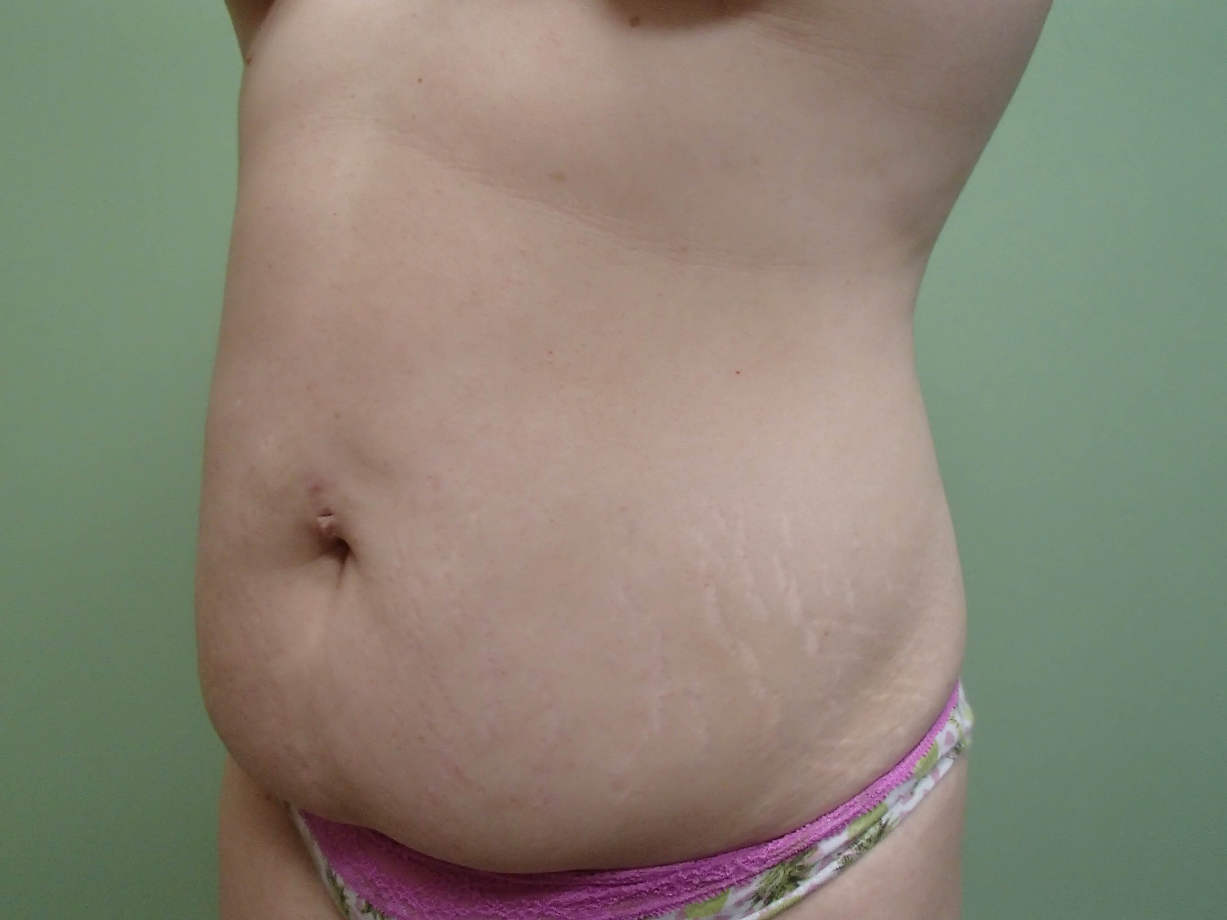 Abdominoplasty w/ Liposuction Before
