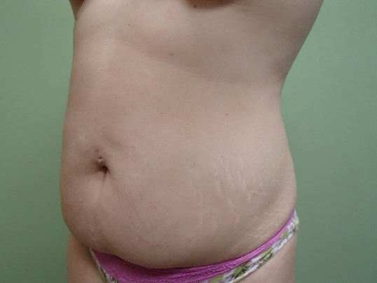 Abdominoplasty w/ Liposuction Before