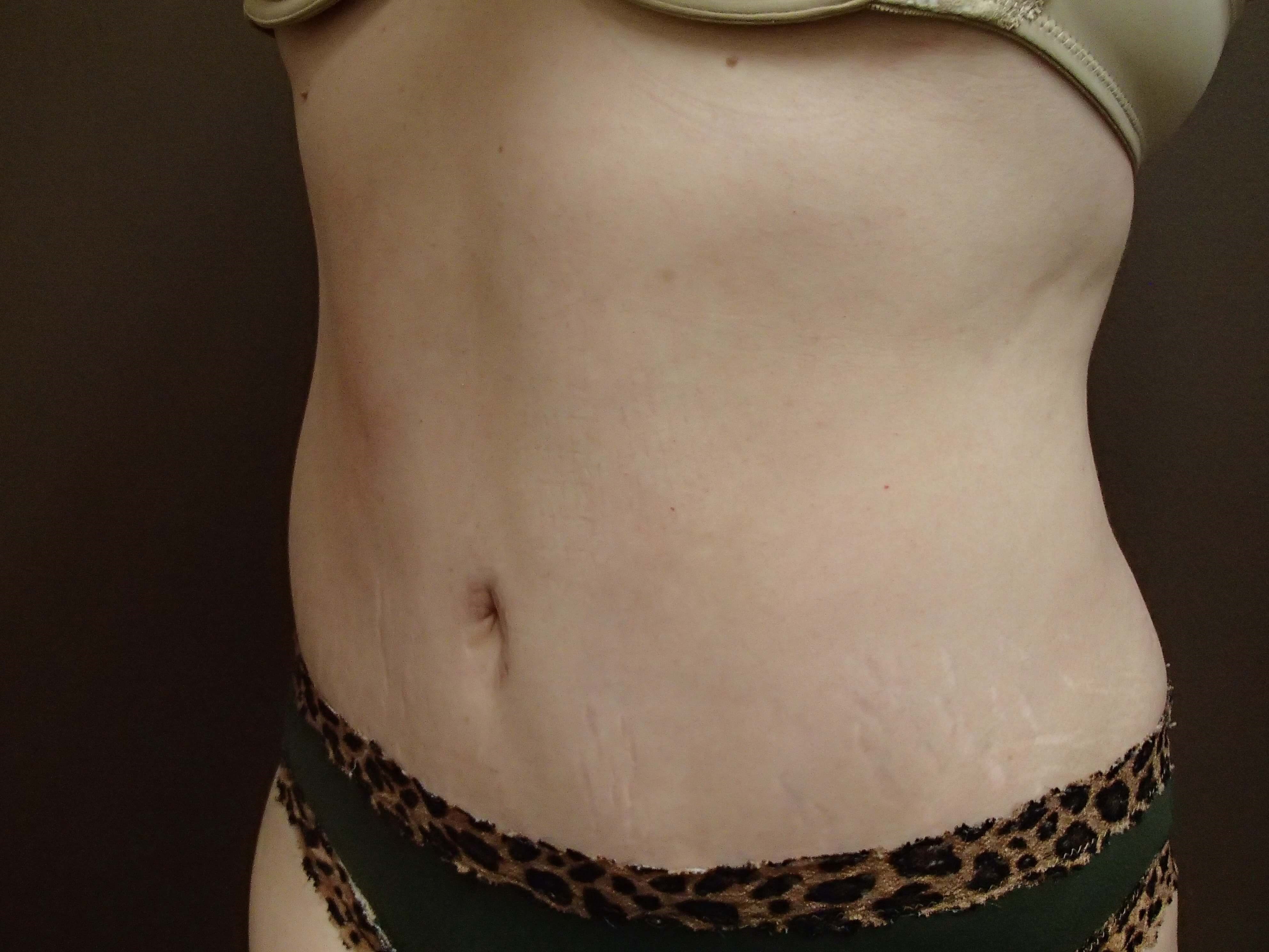 Abdominoplasty w/ Liposuction After