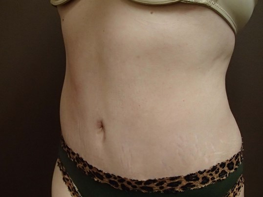 Abdominoplasty w/ Liposuction After