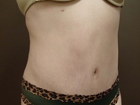 Abdominoplasty w/ Liposuction After