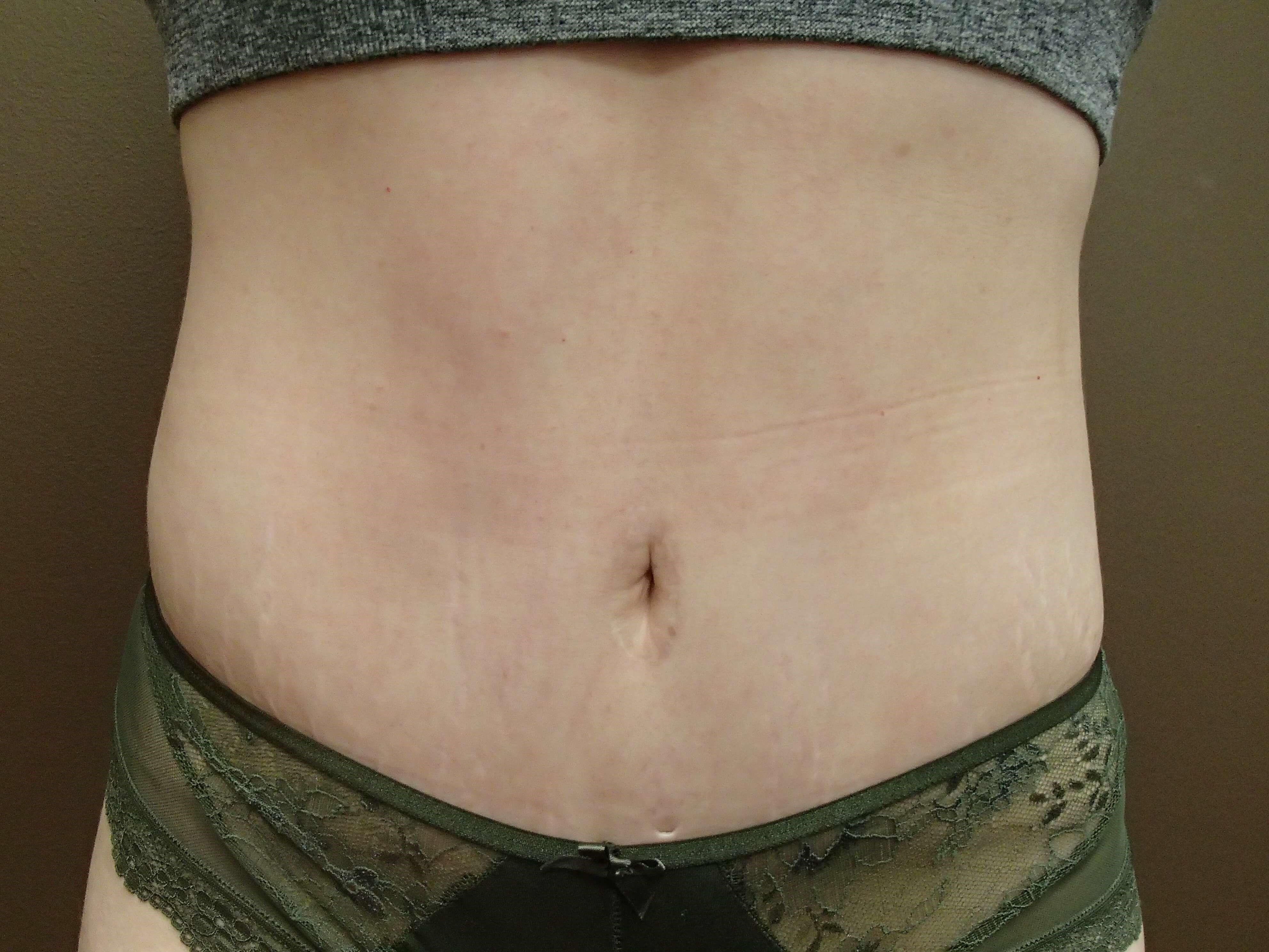 Abdominoplasty w/ Liposuction After
