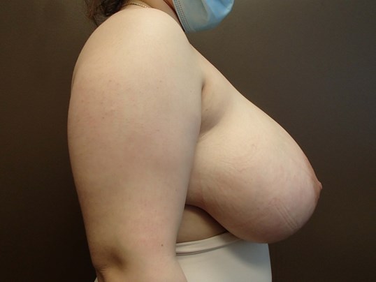 Breast Reduction Before