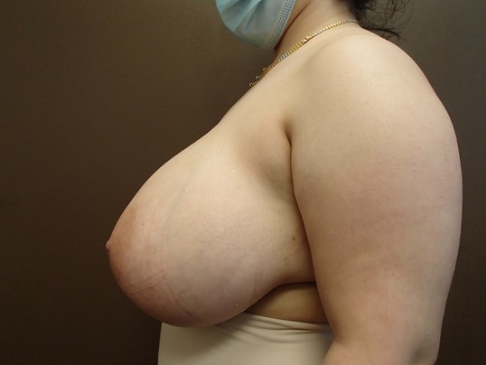 Breast Reduction Before