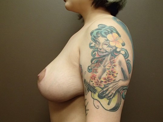 Cosmetic Breast Reduction After