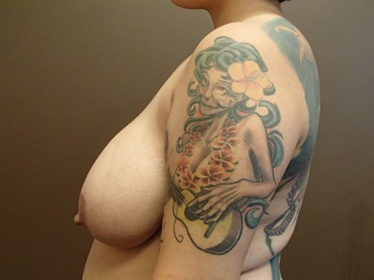 Cosmetic Breast Reduction Before