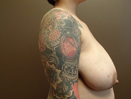 Cosmetic Breast Reduction Before